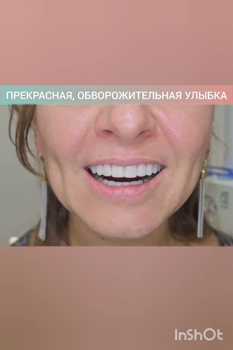 Люминиры без обточки собственных зубов. - YouTube