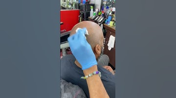 Scalp micro pigmentation Right after 1st session