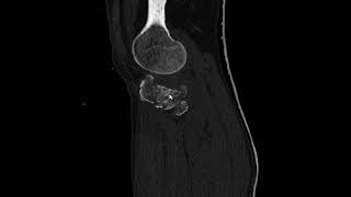 Fratura Do Platô Tibial Lateral