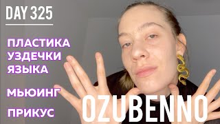 видео: БЕЗ БРЕКЕТОВ день 325: мьюинг для прикуса. Пластика уздечки языка. Аппарат Планаса картинка: БЕЗ БРЕКЕТОВ день 325: мьюинг для прикуса. Пластика уздечки языка. Аппарат Планаса