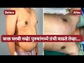 फक्त चरबी नव्हे! पुरुषांमध्ये ग्रंथी वाढते तेव्हा…  | Gynecomastia Explained