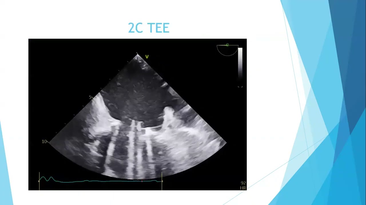 echo Conference 18/2 - Dr. Ramez leon - Metallic mitral valve prosthesis thrombus