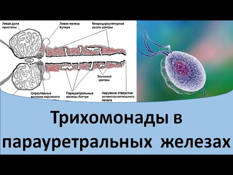 Трихомонады в парауретральных