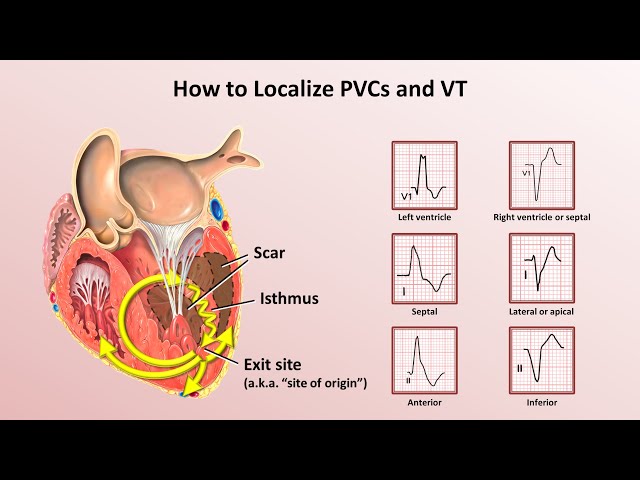 Advanced EKGs - Ventricular Tachycardia (Classification & Localization) class=