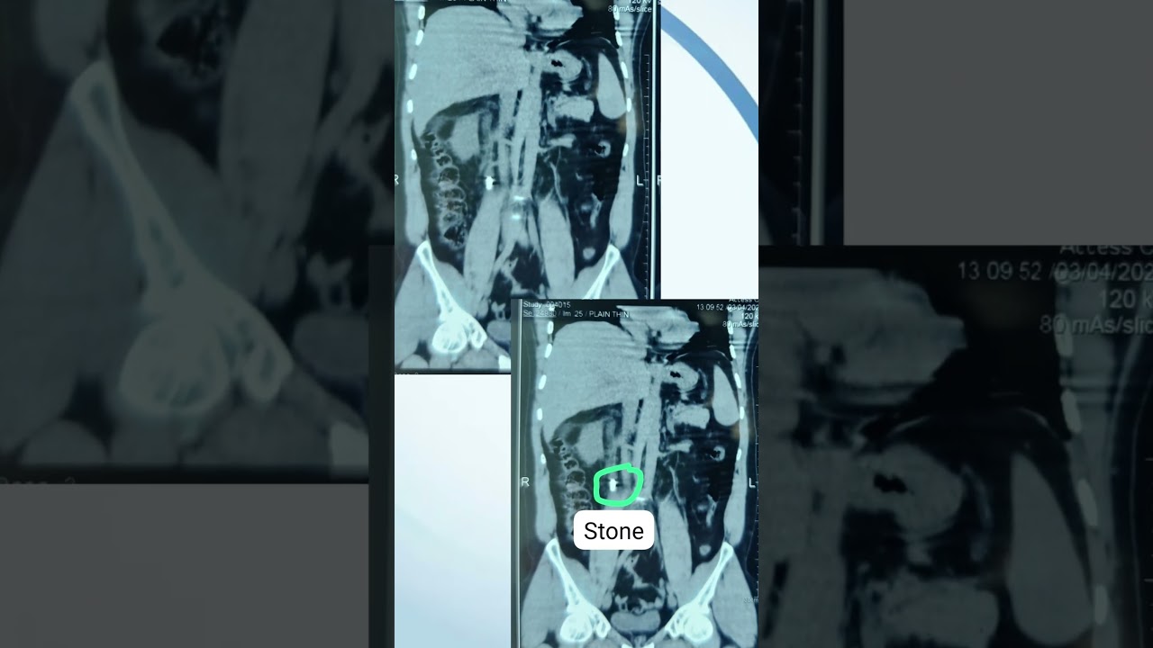 RIRS Surgery at Urology Dept of United Superspeciality Hospital, Gondia