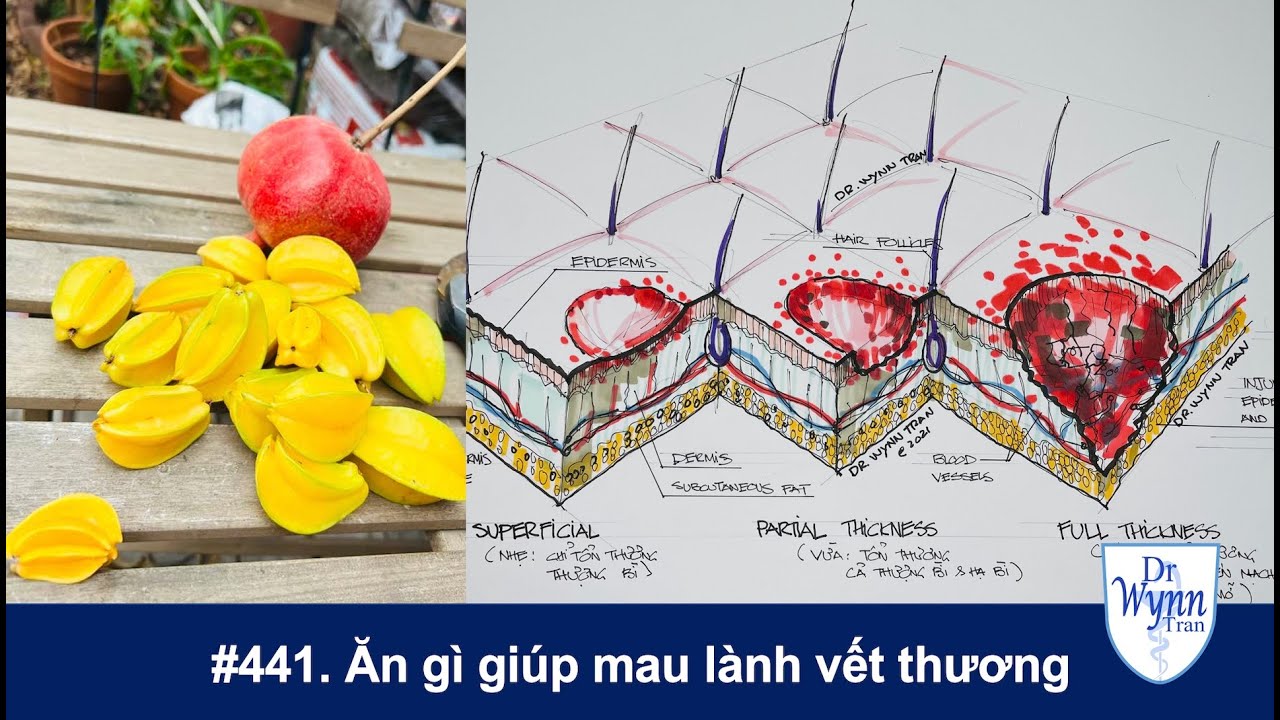 #441. Dinh dưỡng giúp mau lành vết thương
