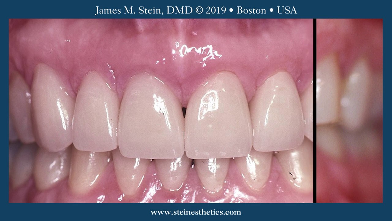 Porcelain Dental Veneers by James M. Stein, D.M.D., Boston 1.1 YouTube