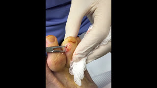 Dr. Todd Brennan removes gout crystals from a patient who has frequent gout attacks!