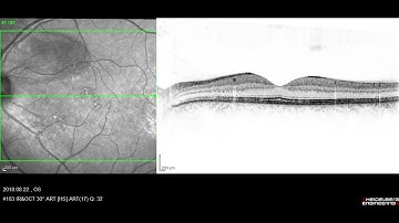 Optical coherence tomography shows Retina Disease, Central serous retinopathy, OS Movie 2018.08.22