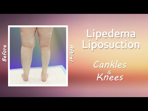 Lipedema Liposuction | Surgery Results | Lipo 360° Legs | Cankles & Knees | Expert Dr. Thomas Su