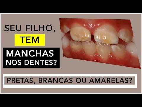 Vídeo: Causas da placa preta nos dentes de uma criança: tratamento