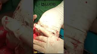Segmental Mandible Reconstruction using PSI | LUCID Implants
