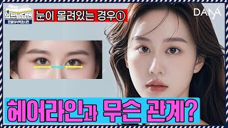 의느님답변📂헤어라인 교정으로 눈 몰림 해결될까?ㅣ눈이 모여있는 경우의 해결 방법①ㅣ다나성형외과(DANA)ㅣ모발이식ㅣ헤어라인교정ㅣ두피문신ㅣ탈모치료