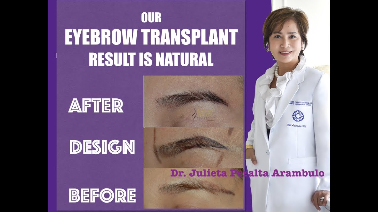 Eyebrow Transplant Result - Fuller Brows by FUE  Hair Transplant in the Philippines