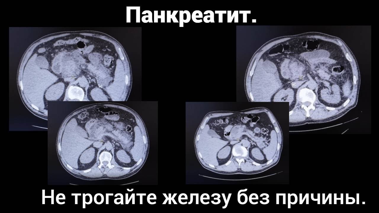 Панкреатит.  Не трогайте железу без причины