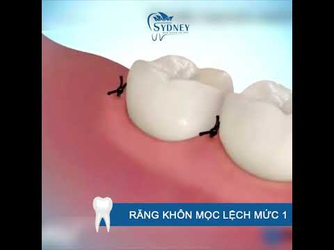 Video NHỔ RĂNG BẰNG SÓNG SIÊU ÂM PIEZOTOME KHÔNG ĐAU - LÀNH... - youtube