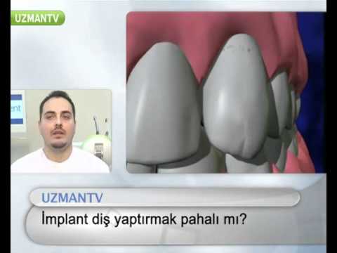 İmplant diş pahalı mıdır?- Serkan Tüzün