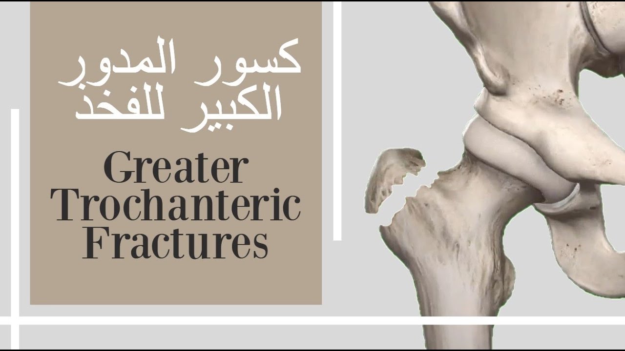 كسور المدور الكبير للفخذ - Greater trochanteric fractures (subtitled)