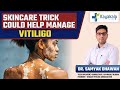 Skincare for Vitiligo!! | Kayakalp Global