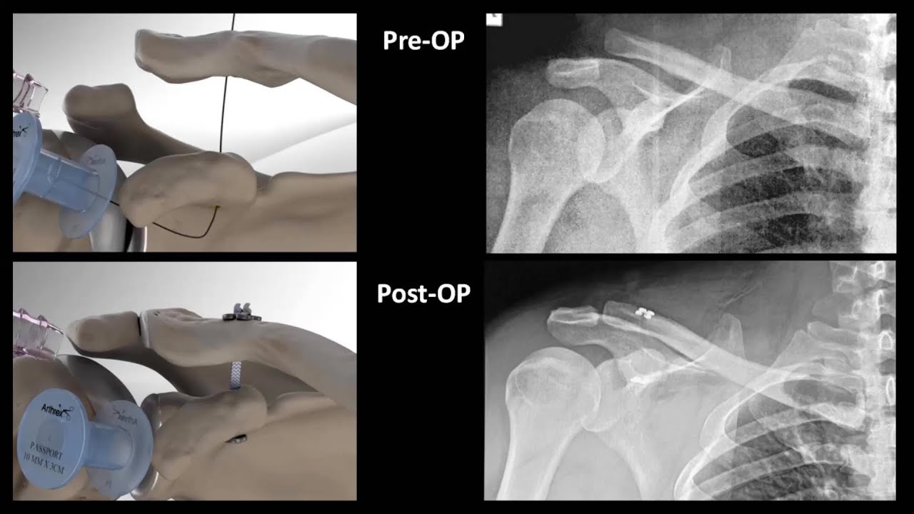 Acromioclavicular Joint Reduction with Arthrex Dogbone via Clavipectoral Block (budgetmealortho