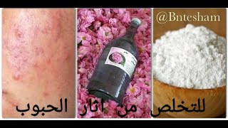 وصفه لعلاج الحبوب واثار الحبوب