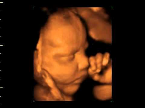 Eco 4d De Nina Con 34 Semanas Youtube