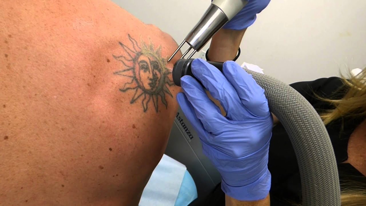 The details of the eyebrow laser tattoo removal process.