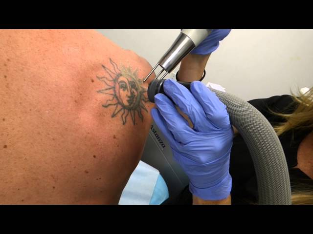 Perth Laser Tattoo Removal (@cleanskinlaser_) • Instagram photos and videos