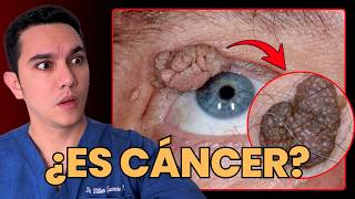 Tumores de piel que parecen cáncer pero no lo son | Dr. William Guerrero