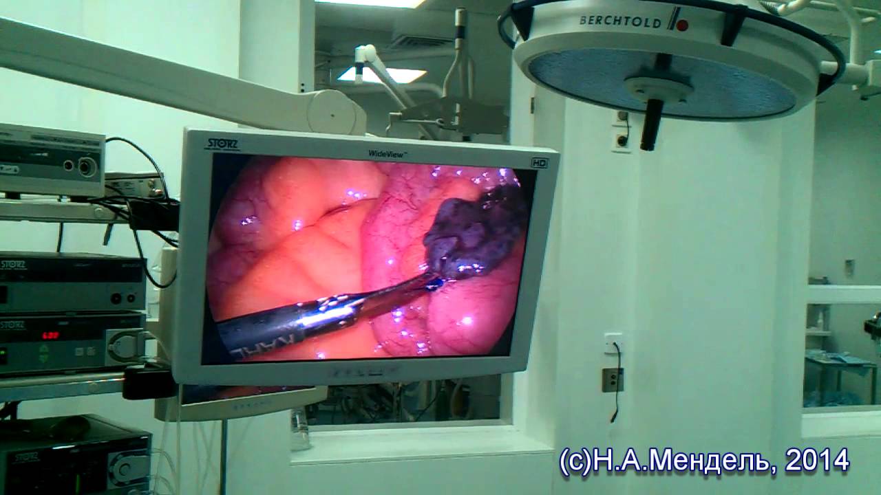 Венозная гемангиома тонкой кишки