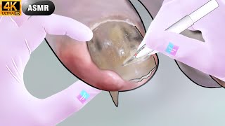 [ASMR] "My toe hurts" Ingrown toenails that penetrate the skin, pus/Witch's foot care animation asmr