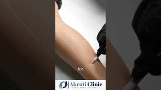Start your journey towards hassle-free, smooth-skin today!#akruticlinic #drdeepakkothari #SkinGlowUp