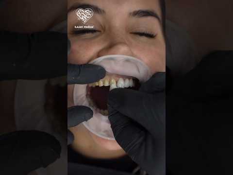 شاهد طريقة تركيب عدسات الاسنان الفينيرز