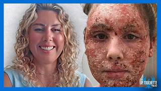 The Most Dramatic TSW Healing Transformation | Louise King
