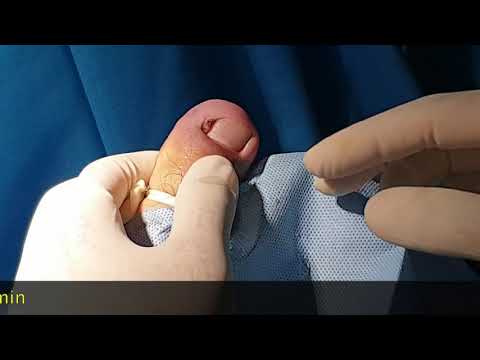 Video: Apa itu plasty dalam istilah medis?