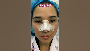 Hành trình 12 ngày sau nâng mũi sụn sinh học | Bác sĩ Trọng #shots #shotrs  #bacsitrong