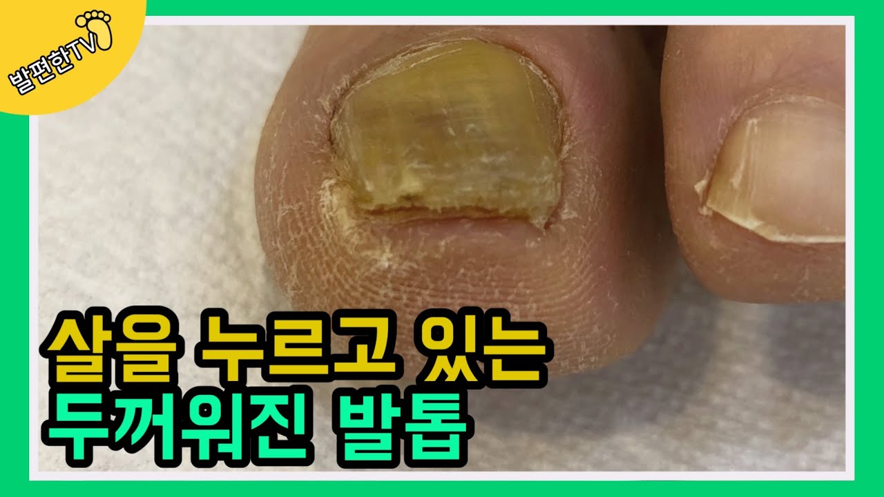 [ENG SUB]살을 누르는 두꺼워진 발톱 pain causing thick toenails YouTube