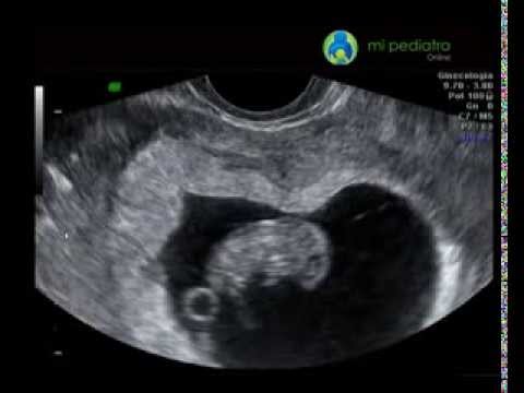 Ecograf a 9 semanas de embarazo 7 de gestaci n