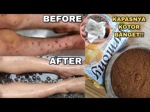 Cara Membuat Obat Koreng Alami