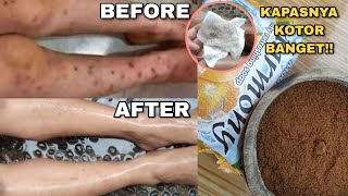 CARA MENGHILANGKAN KORENGAN & MENCERAHKAN KULIT❗