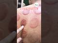 Cupping therapy vlog | Natural pain solution #ytshorts #cuppingtherapy #hijama