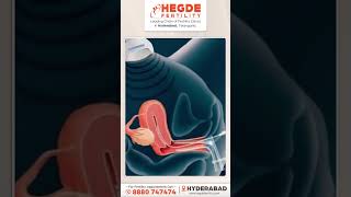 Embryo Transfer in IVF | Is It Painful? |  Fresh vs Frozen | Embryo Transfer Process | #IVF #IUI