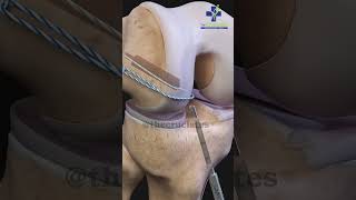 ACL Tear और ACL Reconstruction में क्या फर्क है | ACL Surgery #aclexpert