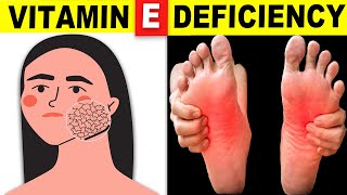 7 Signs Your Body Is Begging for Vitamin E