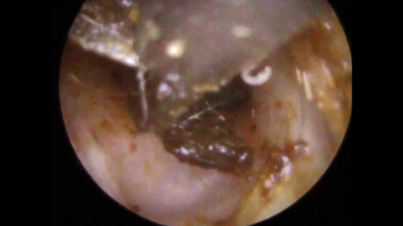 Removing Sticky Ear Wax From Ear Canal & Drum - Mr Neel Raithatha (The Hear Clinic) - YouTube
