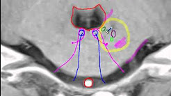 Anterior inferior cerebellar artery