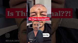 Hair transplant downsides - is this normal ? #hairtransplant #DrHopkirk #hair #hairloss #haircare
