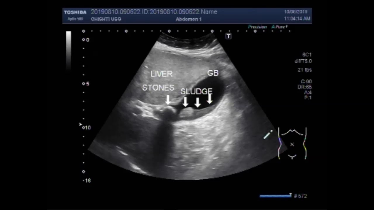 Ultrasound Video showing Cholelithiasis associated with biliary sludge ...