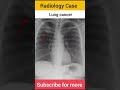 Radiographer paramedical question  radiologycase radiology carcinoma cancer aiims radio