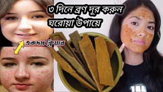 ৩ দিনে মুখের ব্রণ দূর করার ঘরোয়া উপায় ১০০% গ‍্যারান্টি। How to remove pimples/acne only 3 days.. screenshot 5